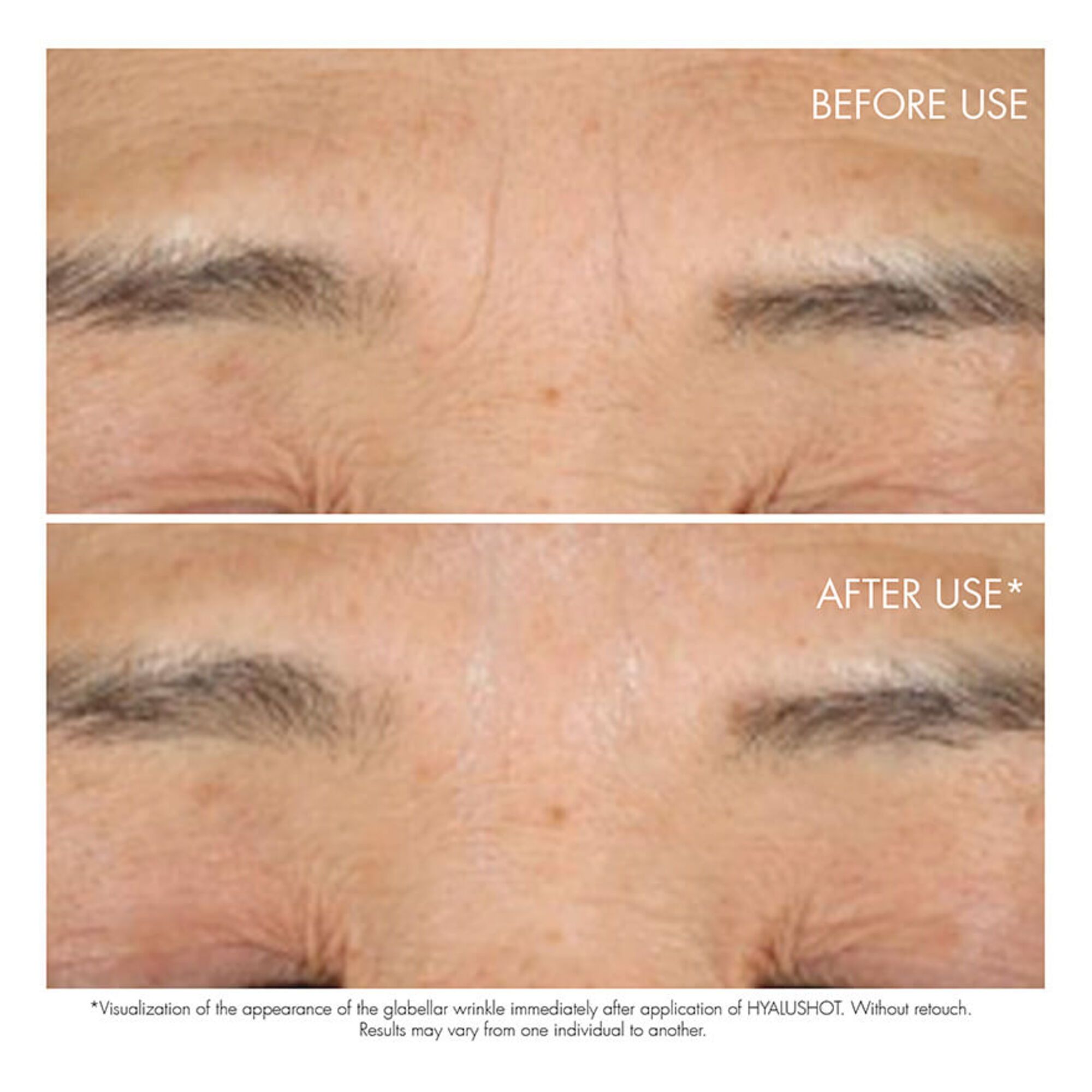 Faltenkorrektor bei bestehenden und sich abzeichnenden Falten